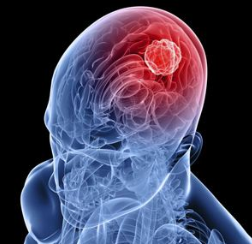 脑癌晚期患者经常会出现哪些症状