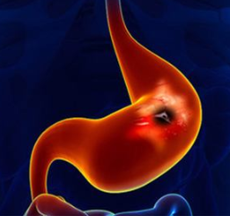 胃癌早期会出现怎样的症状