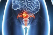 卵巢癌晚期患者的饮食禁忌