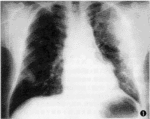 间质性肺炎的确诊 辽宁确认2例新型冠状病毒肺炎确诊