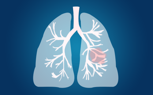 肺癌患者的症状有哪些
