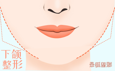 丰唇术是怎么样的？