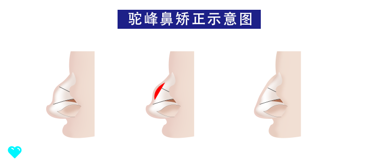 隆鼻术、鼻尖整形术都是怎么样的？