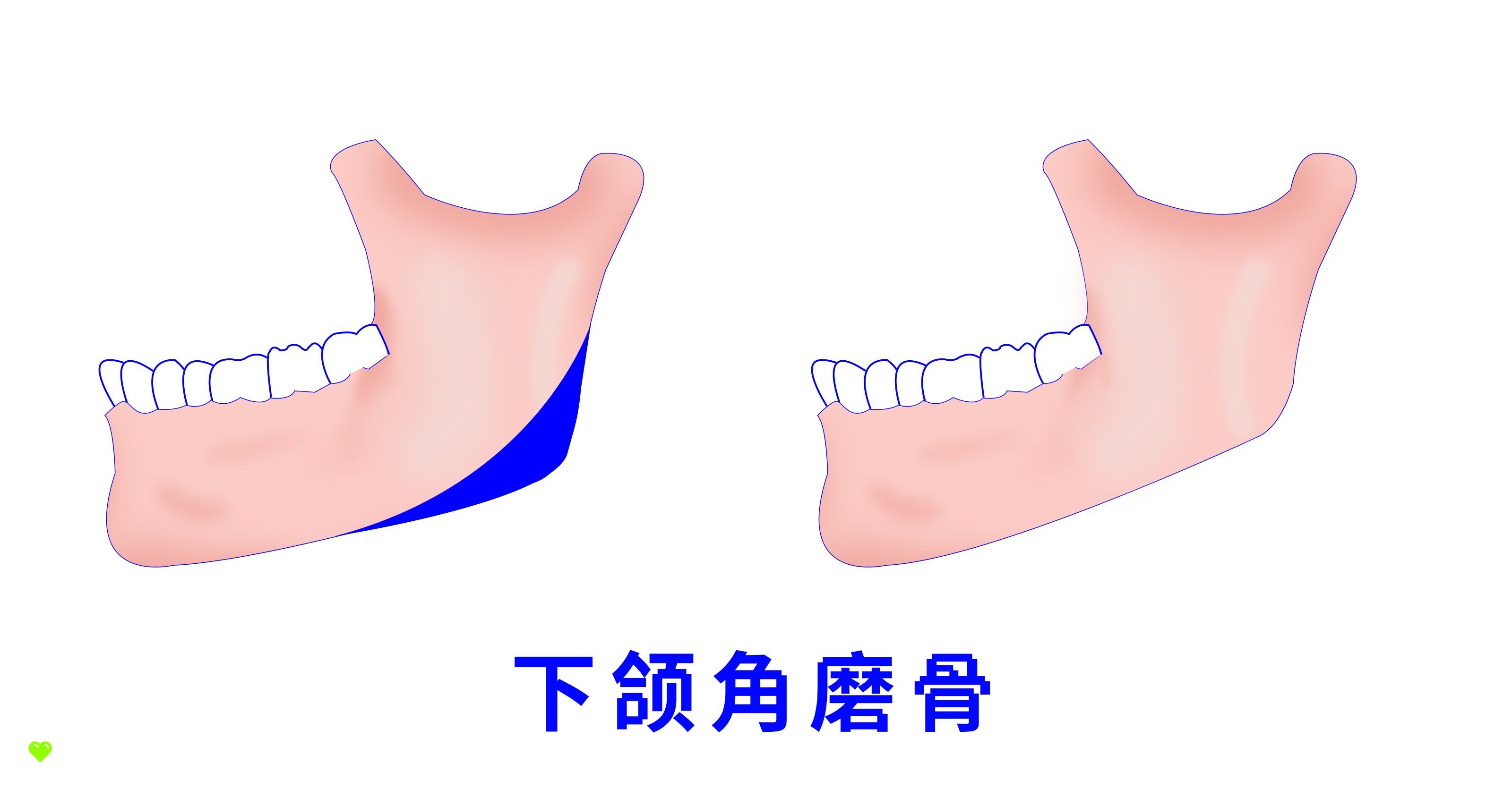【原创插画】颌面，颌骨，下颌角，下颌角磨骨，第二下颌角，下颌缘