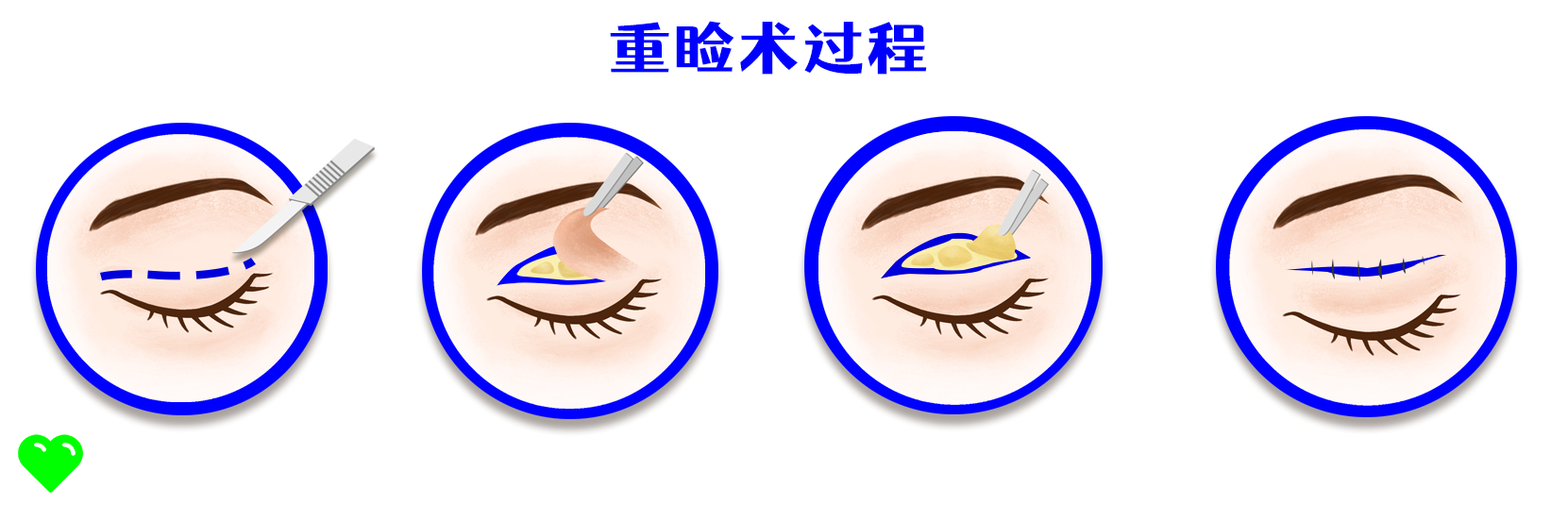 上海做双眼皮哪家整形医院好？做双眼皮的价格是多少钱？