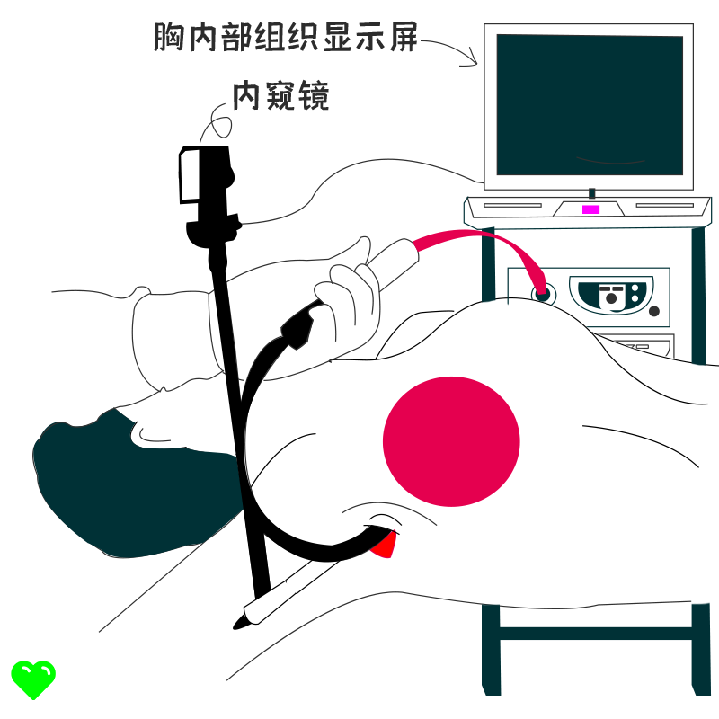武漢隆胸手術需要休息多久？