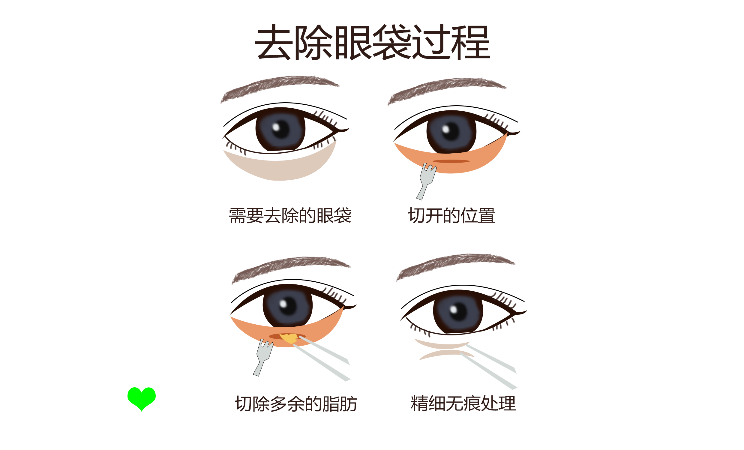 上海祛眼袋有几种手术方法？