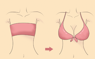 乳房缩小手术安全吗？