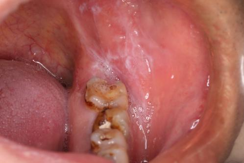 口腔癌如何预防？什么是口腔癌？
