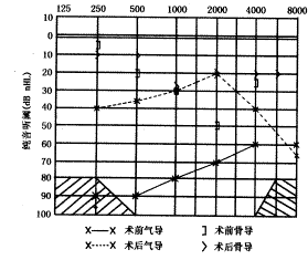 db,右耳73 db,骨导尚好;2 khz处有carhart切迹